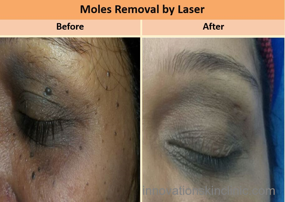 Compound Nevus Removal By Laser